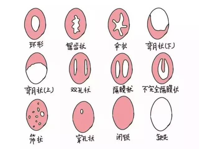 “处女膜”大探秘 科普问答