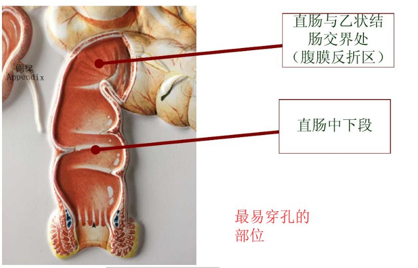 以免肠管破裂